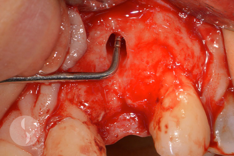 Endodontic abscess