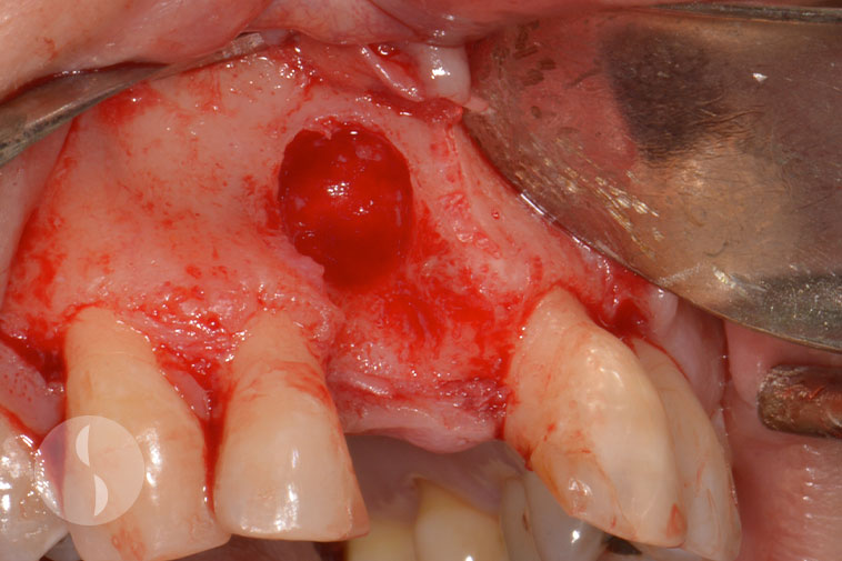 Large buccal defect