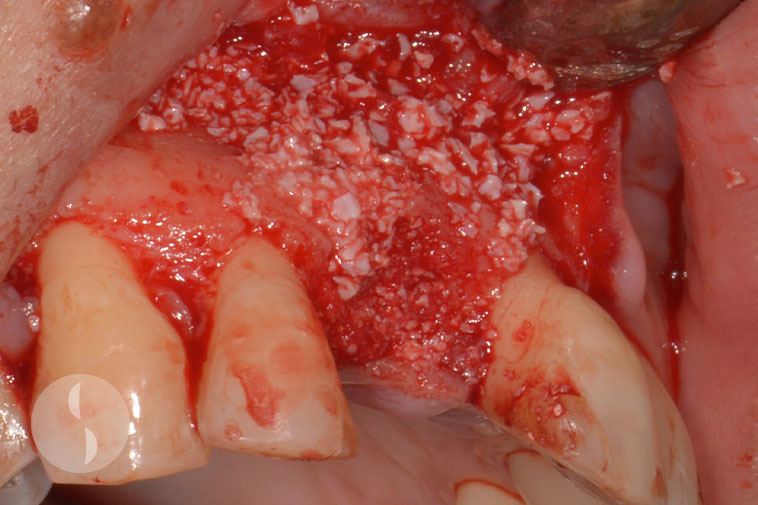 Placement of particulate graft