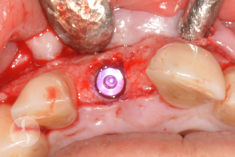 Implant placement in regenerated bone