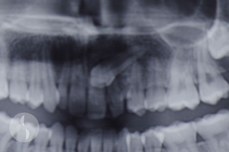 radiograph showing impacted canine