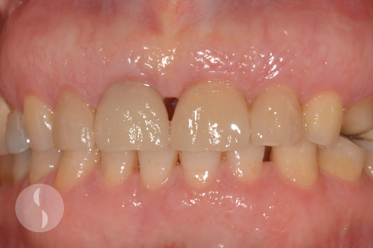 incisors restored with veneers