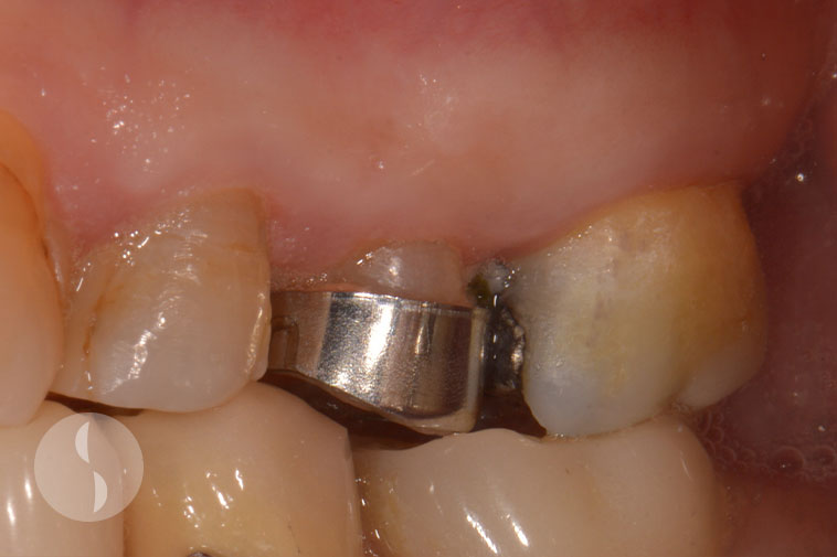 tooth with inadequate ferrule