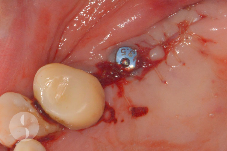implant placed with single stage