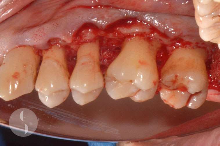 Surgical periodontal access surgery