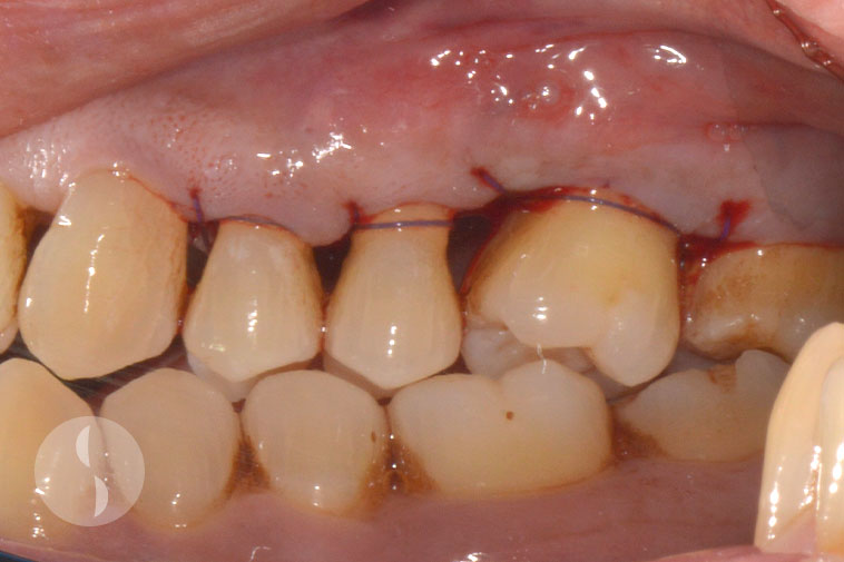 Surgical periodontal surgery