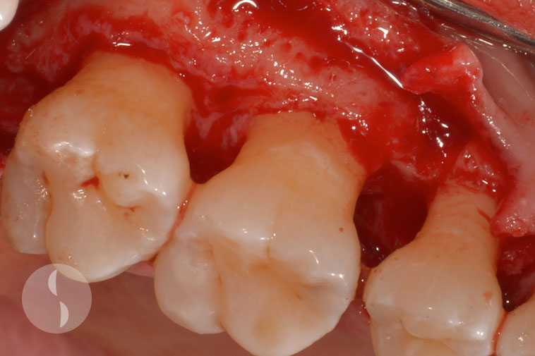 Periodontal access for root decontamination