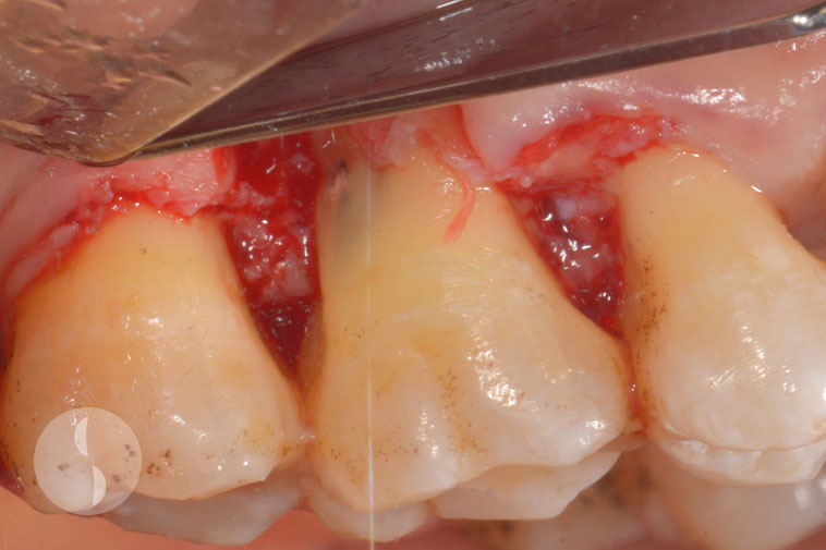disto-buccal root resected
