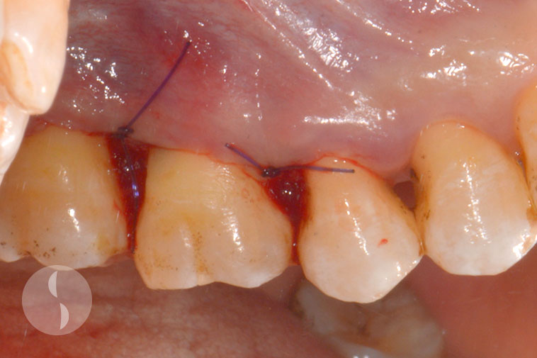 Root Resection post operative