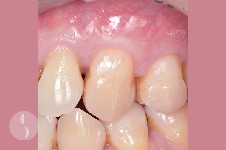 Soft Tissue Grafting after