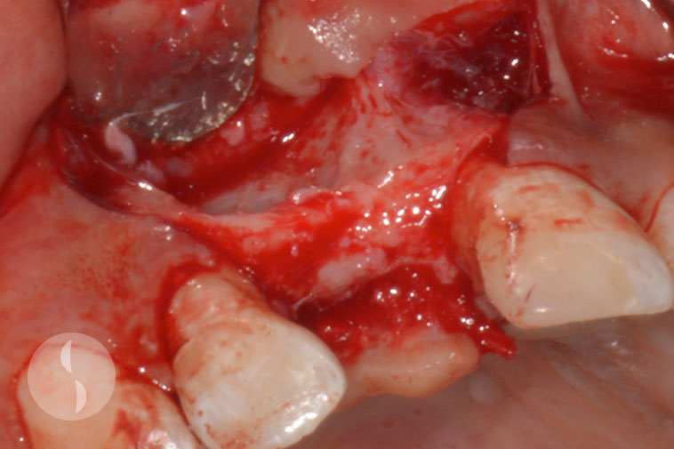Narrow ridge width at implant