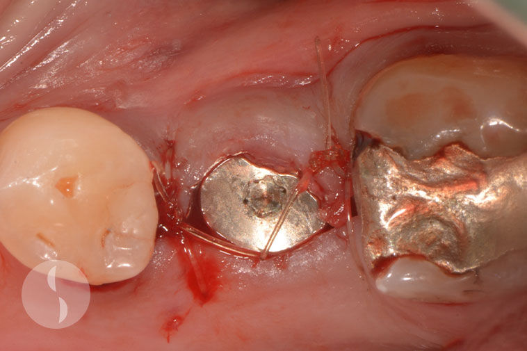 single stage implant surgery