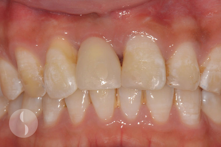 Provisional crown at Implant