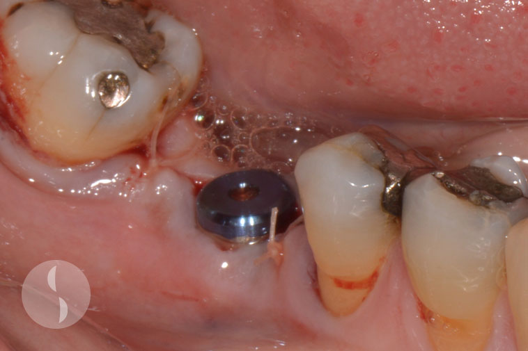 Implant placed with single stage