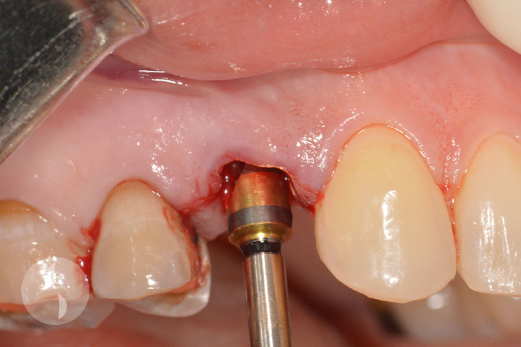 Immediate implant placement