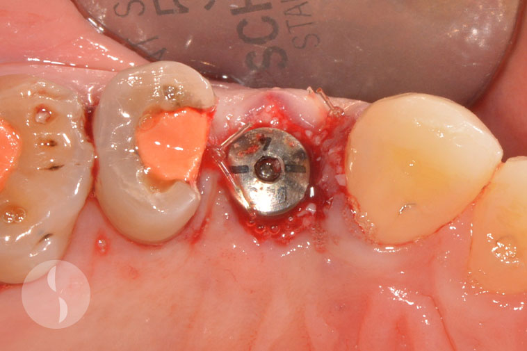 Immediate implant with grafting