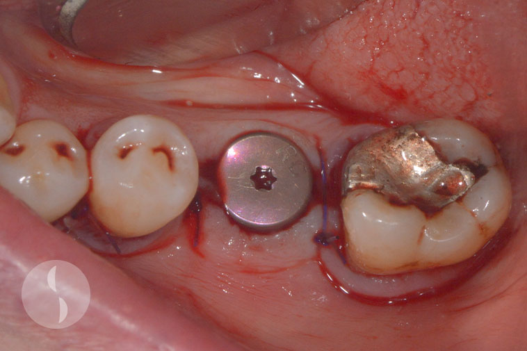 implant placed as single stage