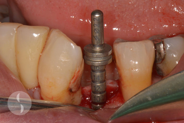 Narrow space for implant