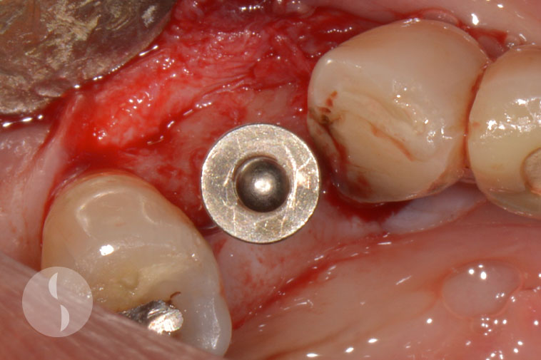 Implant placed in prosthetically