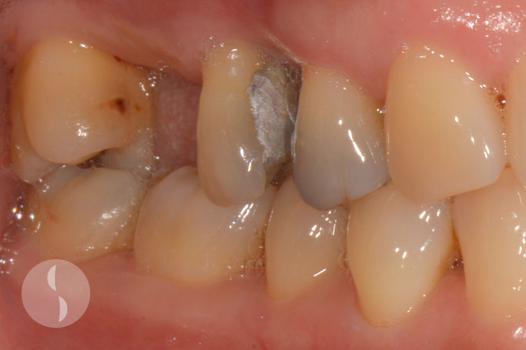 Pre-operative situation in implant