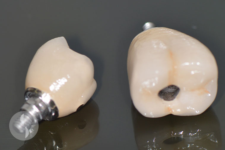 Screw retained crowns