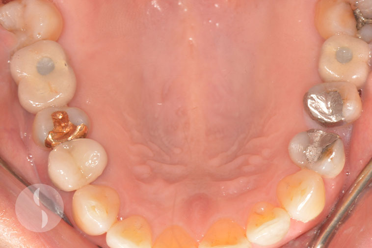 screw retained crowns