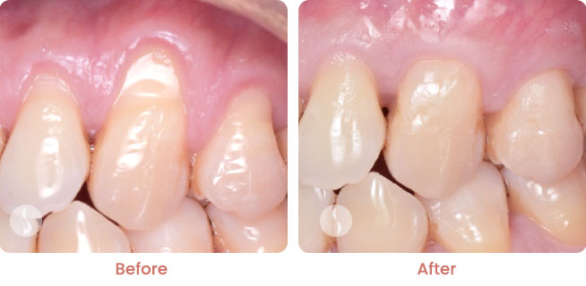 Receding Gums before after